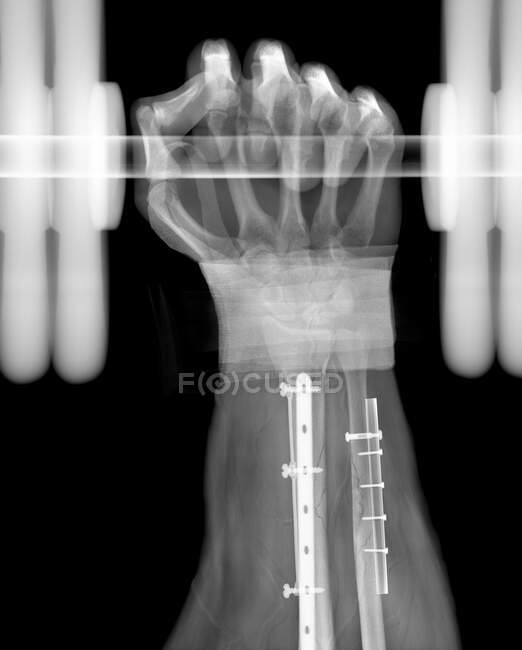Gebrochener Arm, Röntgenbild. — Stockfoto