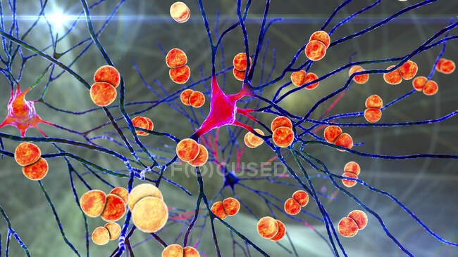 Бактеріальна інфекція мозку. Концептуальна комп'ютерна ілюстрація, що показує бактерії Streptococcus pneumoniae, одна з основних причин бактеріального менінгіту та менінгоенцефаліту, що заражають клітини мозку — стокове фото