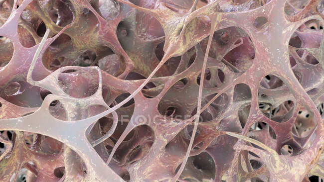 Illustration der Knochenstruktur, die von Osteoporose betroffen ist. Die Ausdünnung der Knochenmatrix ist sichtbar — Stockfoto