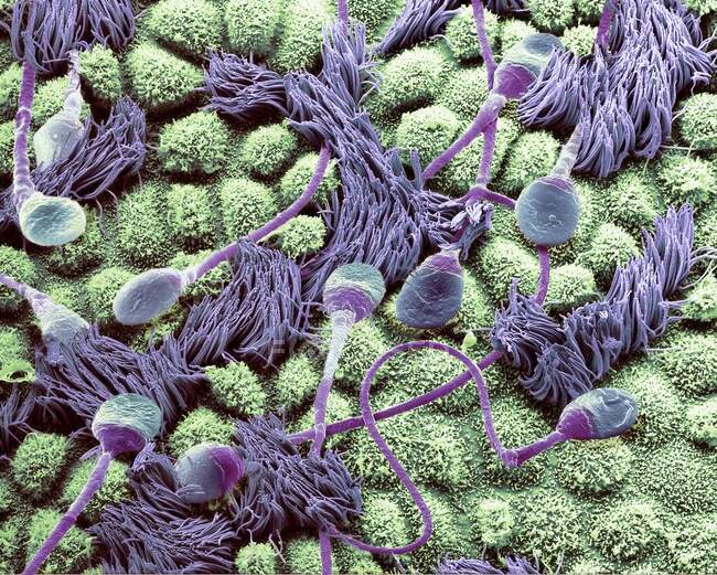 Sperma in einem Eileiter. Farbige Zusammensetzung Rasterelektronenmikroskopie (REM) menschlicher Spermien, die durch eine Eileiterröhre (Ooduct) einer Frau wandern — Stockfoto