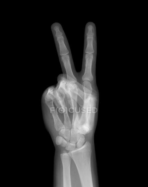 Peace hand gesture, X-ray. — Stock Photo