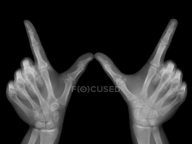 Cualquier gesto de las manos, rayos X. - foto de stock