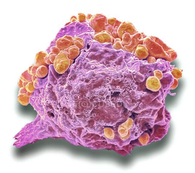 Célula cancerosa del linfoma. Micrógrafo electrónico de barrido coloreado (SEM) de una célula del linfoma que muestra cambios apoptóticos tempranos. Un linfoma es una célula del sistema inmunitario que se ha vuelto cancerosa. La célula se vuelve inmortal y puede crecer indefinidamente - foto de stock