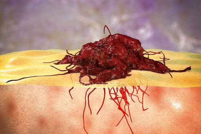 Invasión del cáncer en los tejidos circundantes, ilustración conceptual por computadora. - foto de stock