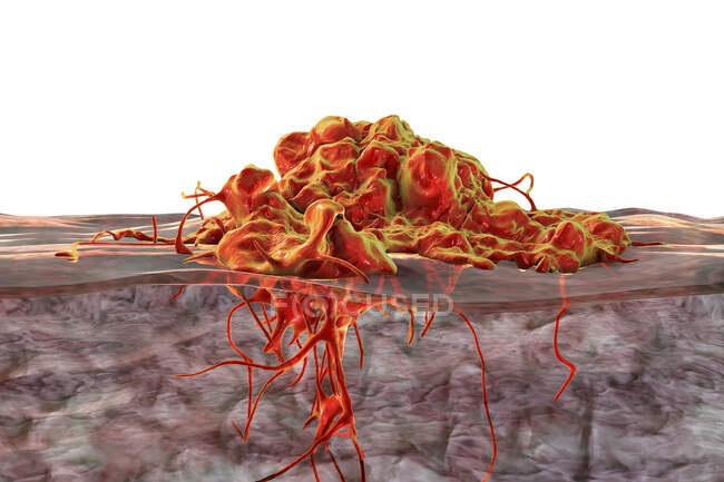 Invasione di cancro nei tessuti circostanti, illustrazione concettuale del computer. — Foto stock