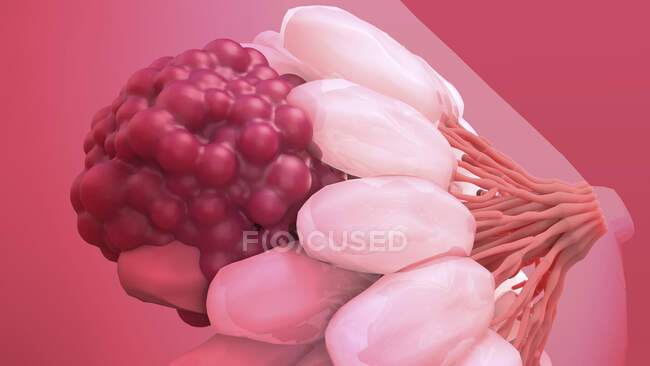Рак молочної залози. Ілюстрація злоякісної (каудальної) пухлини (червоної) у жіночих грудях — стокове фото