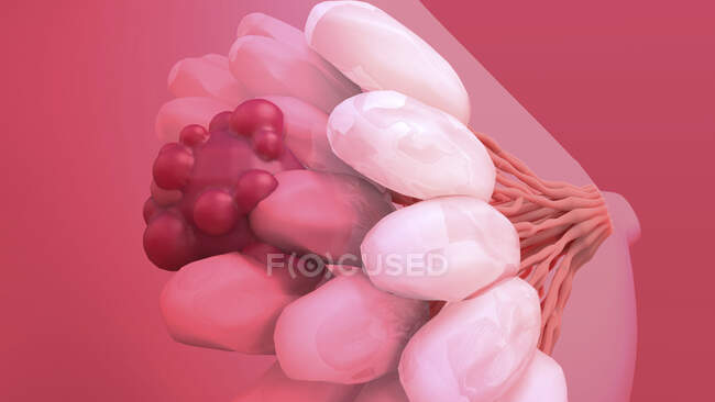 Cáncer de mama. Ilustración del tumor maligno (canceroso) (rojo) en la mama de la mujer - foto de stock
