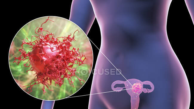 Рак яєчників. Комп'ютерна ілюстрація, що показує ракову пухлину в матці і крупним планом вигляд ракової клітини — стокове фото