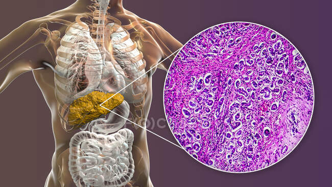 Жирний цироз. Комп'ютерна ілюстрація та легкий мікрограф розділу через людську печінку з первинним біліарним цирозом. Цироз (англ. Cirrhosis) - це хвороба, при якій ділянки фіброзу (внутрішнє рубцювання) руйнують внутрішню структуру печінки. — стокове фото