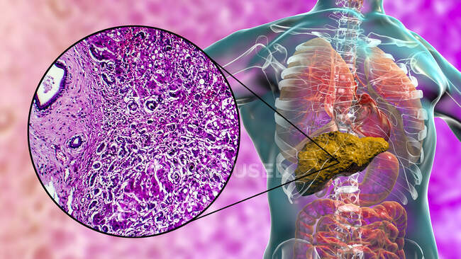 Жирний цироз. Комп'ютерна ілюстрація та легкий мікрограф розділу через людську печінку з первинним біліарним цирозом. Цироз (англ. Cirrhosis) - це хвороба, при якій ділянки фіброзу (внутрішнє рубцювання) руйнують внутрішню структуру печінки. — стокове фото