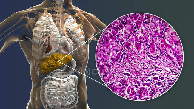 Liver cirrhosis. Computer illustration and light micrograph of a section through a human liver with from primary biliary cirrhosis. Cirrhosis is a disease in which bands of fibrosis (internal scarring) break up the internal structure of the liver — Stock Photo