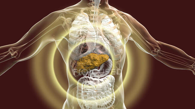 Hígado con cirrosis, ilustración por computadora. La cirrosis es una consecuencia de la enfermedad hepática crónica caracterizada por fibrosis y cicatrización del tejido - foto de stock