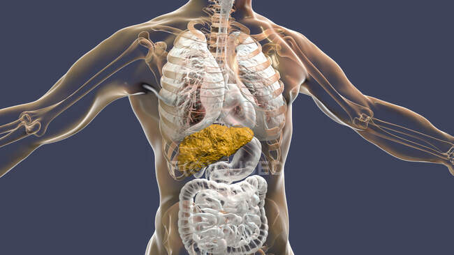 Hígado con cirrosis, ilustración por computadora. La cirrosis es una consecuencia de la enfermedad hepática crónica caracterizada por fibrosis y cicatrización del tejido - foto de stock