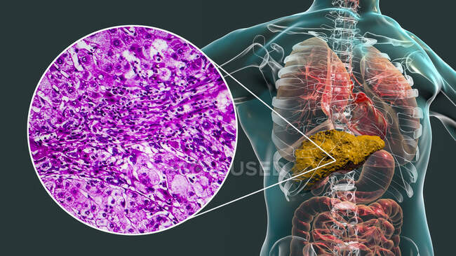 Cirrosis hepática. Ilustración por computadora y micrografía ligera de una sección a través de un hígado humano con cirrosis, mostrando fibrosis y falta de anatomía funcional del hígado. - foto de stock