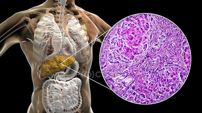 Cirrosis hepática. Ilustración por ordenador y micrografía ligera de una sección a través de un hígado humano con nódulos hepatocelulares asociados a cirrosis. - foto de stock