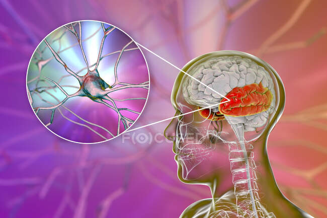 Cérebro humano com destaque para lobo temporal e visão de perto dos neurônios localizados no lobo temporal, ilustração computadorizada — Fotografia de Stock