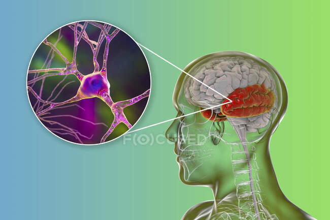 Cerebro humano con lóbulo temporal resaltado y vista de cerca de neuronas localizadas en lóbulo temporal, ilustración por computadora - foto de stock