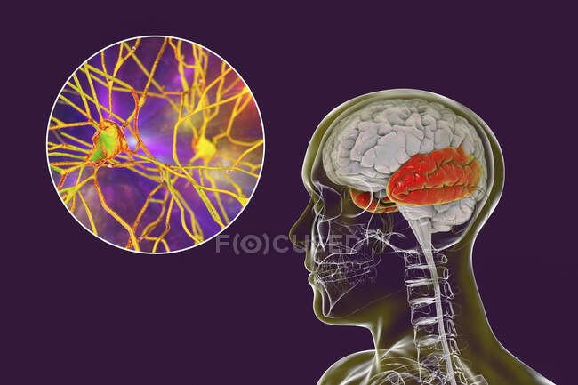 Cerebro humano con lóbulo temporal resaltado y vista de cerca de neuronas localizadas en lóbulo temporal, ilustración por computadora - foto de stock