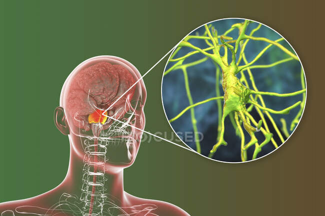 Menschliches Gehirn mit hervorgehobenen Ponen und Neuronen, Illustration. Menschliches Gehirn mit hervorgehobenen Pons Varolii und Nahaufnahme pyramidenförmiger Neuronen (Nervenzellen) in Pons — Stockfoto
