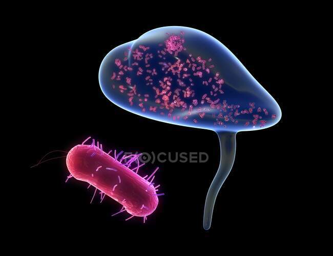 Бактеріальний цистит, ілюстрація. Цистит (запалення сечового міхура) може бути викликаний бактерією E. coli (червоний ). — стокове фото