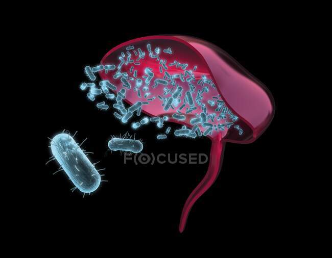 Бактеріальний цистит, ілюстрація. Цистит (запалення сечового міхура) може бути викликаний бактерією E. coli (червоний ). — стокове фото