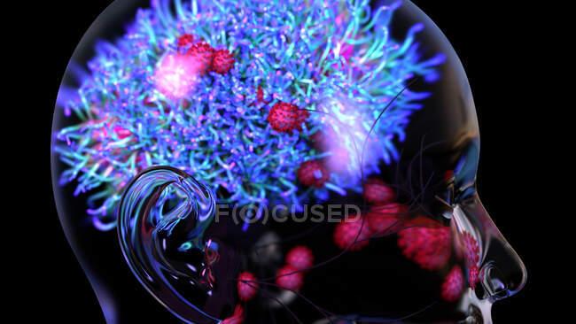 Ilustración de virus SARS-Cov-2 (rojo), la causa de Covid-19, infectando el cerebro - foto de stock