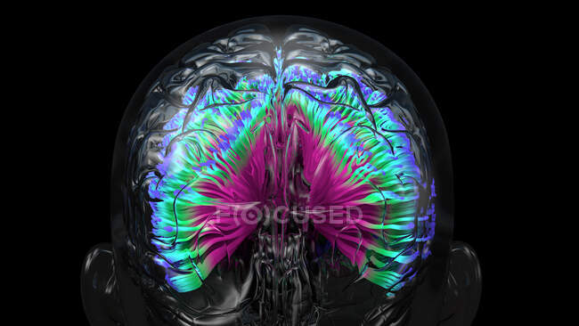 Infection cérébrale, illustration conceptuelle. — Photo de stock