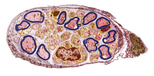 Периферійний нерв. Кольоровий електронний мікрограф передачі (TEM) ділянки через невеликий периферійний нерв. Мієлін (синій) це ізолюючий жировий шар, який оточує мієлінові нервові волокна (рожевий ) — стокове фото
