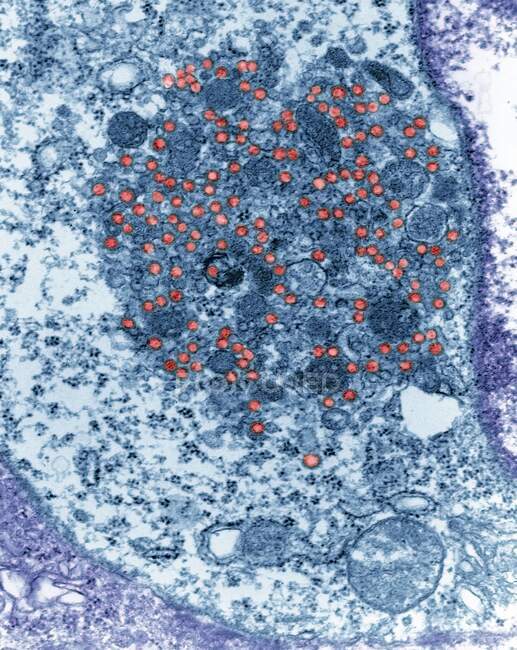 Partículas del virus del tumor mamario del ratón (MMTV) (azul), micrografía electrónica de transmisión coloreada (TEM). MMTV induce tumores malignos en las glándulas mamarias de ciertas cepas de ratones de laboratorio - foto de stock