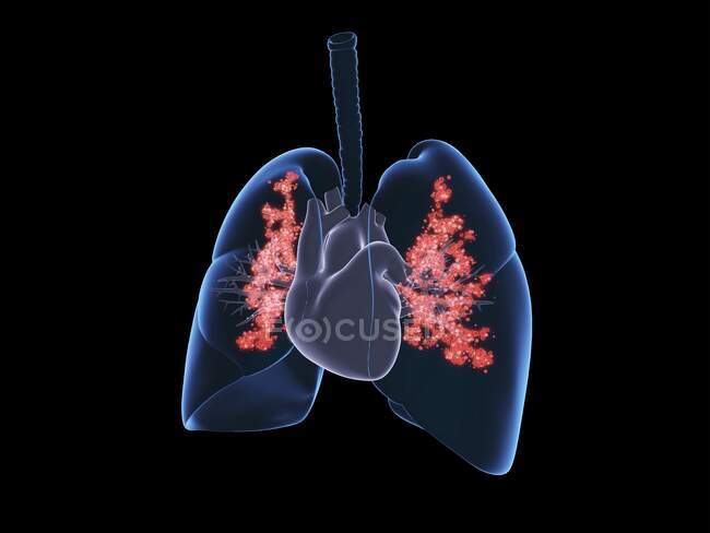 Infection pulmonaire virale, illustration. Poumons enflammés infectés par des particules virales. — Photo de stock