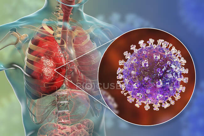 Nipah virus in lungs, conceptual computer illustration. Nipah virus is zoonotic (transmitted to humans from animals) and was first found in Malaysia and Singapore in people who had close contact with pigs — Stock Photo
