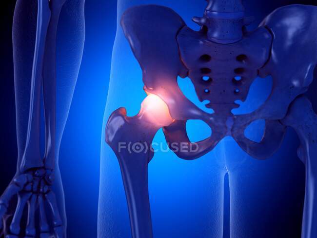 Articulación dolorosa de la cadera, ilustración por computadora — Stock Photo
