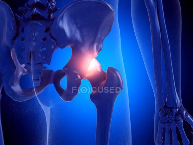Articulación dolorosa de la cadera, ilustración por computadora - foto de stock