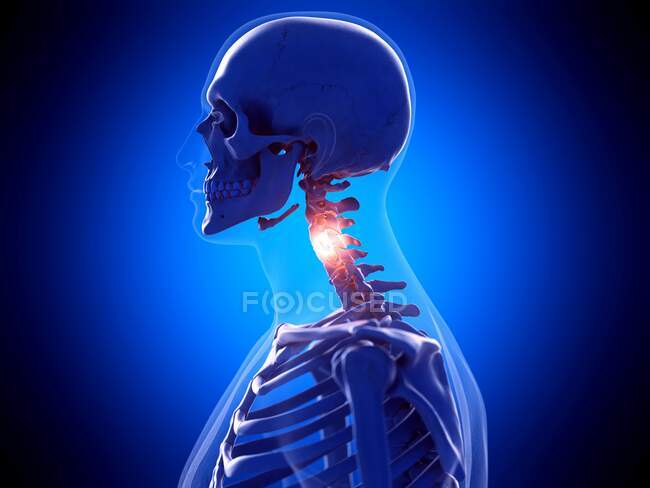 Cuello doloroso, ilustración por computadora - foto de stock