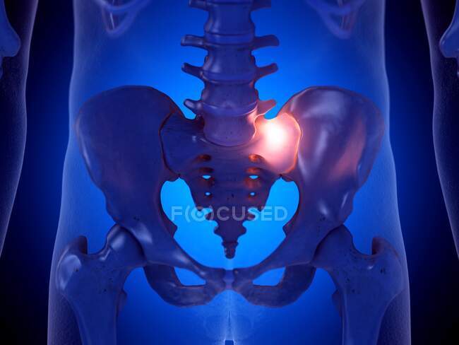 Painful sacroiliac joint, computer illustration — Stock Photo