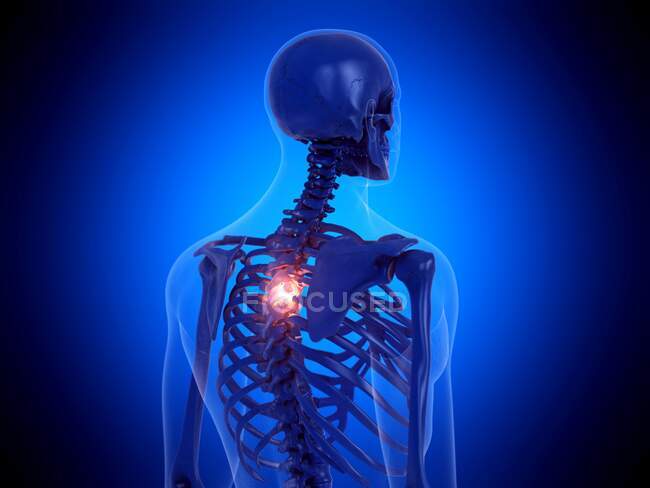 Espina dorsal dolorosa, ilustración por computadora — Stock Photo
