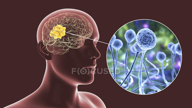 Mucormicosi cerebrale, una lesione cerebrale causata da Mucor sp. funghi, noto anche come fungo nero, con vista da vicino dei funghi, illustrazione al computer. Mucor sp. i funghi si trovano nel suolo e nella materia organica in decomposizione e sono comuni stampi per interni — Foto stock
