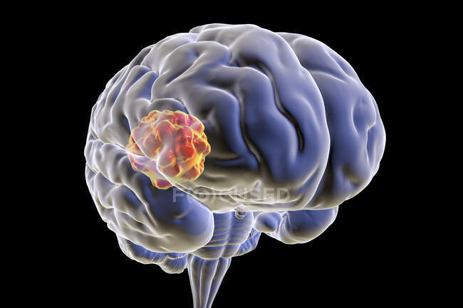 Mucormycose cérébrale, une lésion cérébrale causée par Mucor sp. champignons, également connu sous le nom de champignon noir, avec vue rapprochée des champignons, illustration par ordinateur. Mucor sp. champignons se trouvent dans le sol et la matière organique en décomposition et sont des moisissures intérieures courantes — Photo de stock