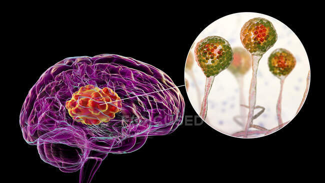 Mucormicose cerebral, uma lesão cerebral causada por Mucor sp. fungos, também conhecidos como fungos negros, com visão aproximada de fungos, ilustração computacional. Mucor sp. fungos são encontrados no solo e na matéria orgânica em decomposição e são moldes internos comuns — Fotografia de Stock