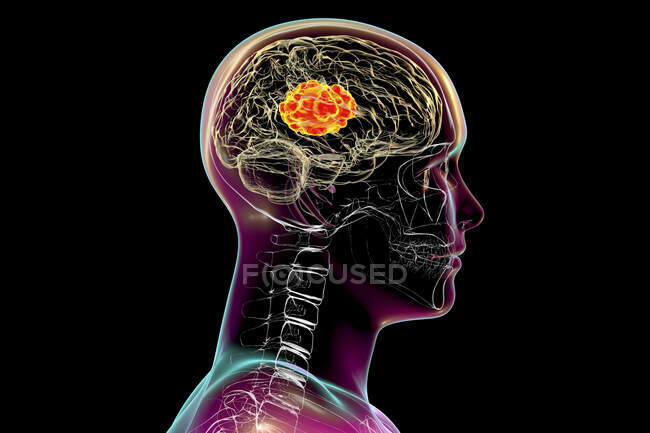 Mucormicosi cerebrale, una lesione cerebrale causata da Mucor sp. funghi, noto anche come fungo nero, con vista da vicino dei funghi, illustrazione al computer. Mucor sp. i funghi si trovano nel suolo e nella materia organica in decomposizione e sono comuni stampi per interni — Foto stock