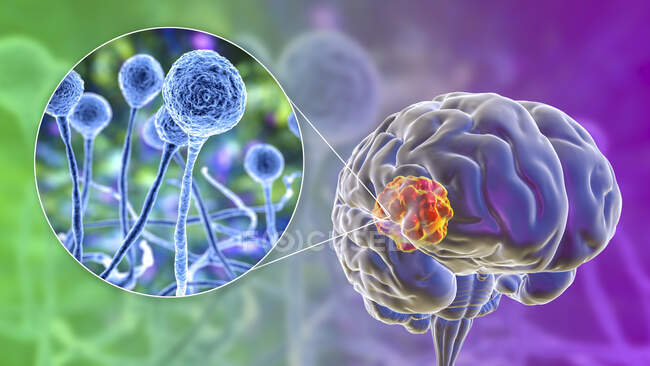 Мукормикоз мозга, повреждение мозга, вызванное Mucor sp. грибы, также известные как черные грибы, с крупным планом грибов, компьютерные иллюстрации. Mucor sp. грибы находятся в почве и разлагающихся органических веществ и являются общими крытых форм — стоковое фото