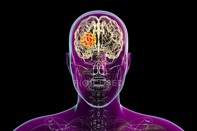 Мозковий мукормікоз, ураження мозку, викликане мукор-спере. гриби, також відомі як чорні гриби, з видом крупним планом гриби, комп'ютерна ілюстрація. Мюхор-спец. гриби зустрічаються в ґрунті і розпадаються органічні речовини і є загальними внутрішніми формами — стокове фото