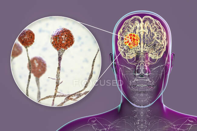 Brain mucormycosis, a brain lesion caused by Mucor sp. fungi, also known as black fungus, with closeup view of fungi, computer illustration. Mucor sp. fungi are found in soil and decaying organic matter and are common indoor moulds — Stock Photo