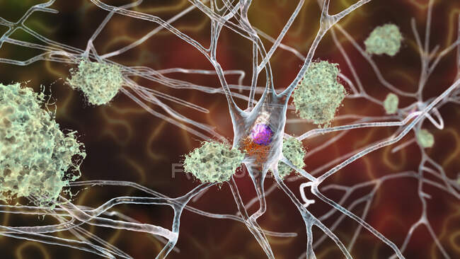 Хвороба Альцгеймера. Ілюстрація амілоїдних бляшок між нейронами та нейрофібрилярними щелепами всередині нейронів. Амілоїдні бляшки є характерними рисами хвороби Альцгеймера. — стокове фото