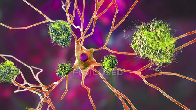 Alzheimer. Illustration amyloider Plaques zwischen Neuronen und neurofibrillären Verwicklungen innerhalb von Neuronen. Amyloid-Plaques sind charakteristische Merkmale der Alzheimer-Krankheit — Stockfoto