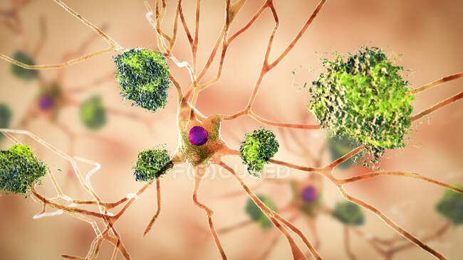 Хвороба Альцгеймера. Ілюстрація амілоїдних бляшок між нейронами та нейрофібрилярними щелепами всередині нейронів. Амілоїдні бляшки є характерними рисами хвороби Альцгеймера. — стокове фото