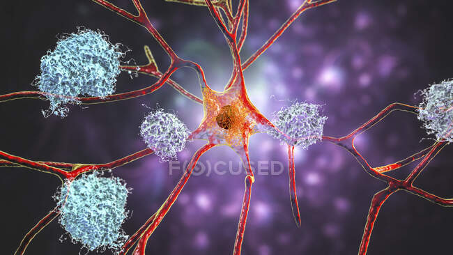 La maladie d'Alzheimer. Illustration de plaques amyloïdes parmi les neurones et les enchevêtrements neurofibrillaires à l'intérieur des neurones. Les plaques amyloïdes sont caractéristiques de la maladie d'Alzheimer — Photo de stock
