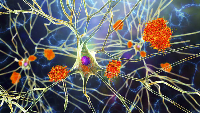 Alzheimer's disease. Illustration of amyloid plaques amongst neurons and neurofibrillary tangles inside neurons. Amyloid plaques are characteristic features of Alzheimer's disease — Stock Photo