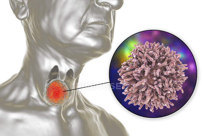Cancro da glândula tireóide com visão de close-up de células cancerosas, ilustração do computador. — Fotografia de Stock