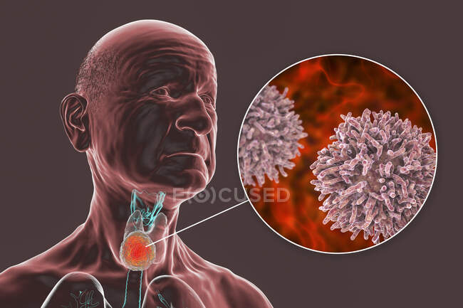 Рак щитовидной железы с крупным планом раковых клеток, компьютерная иллюстрация. — стоковое фото
